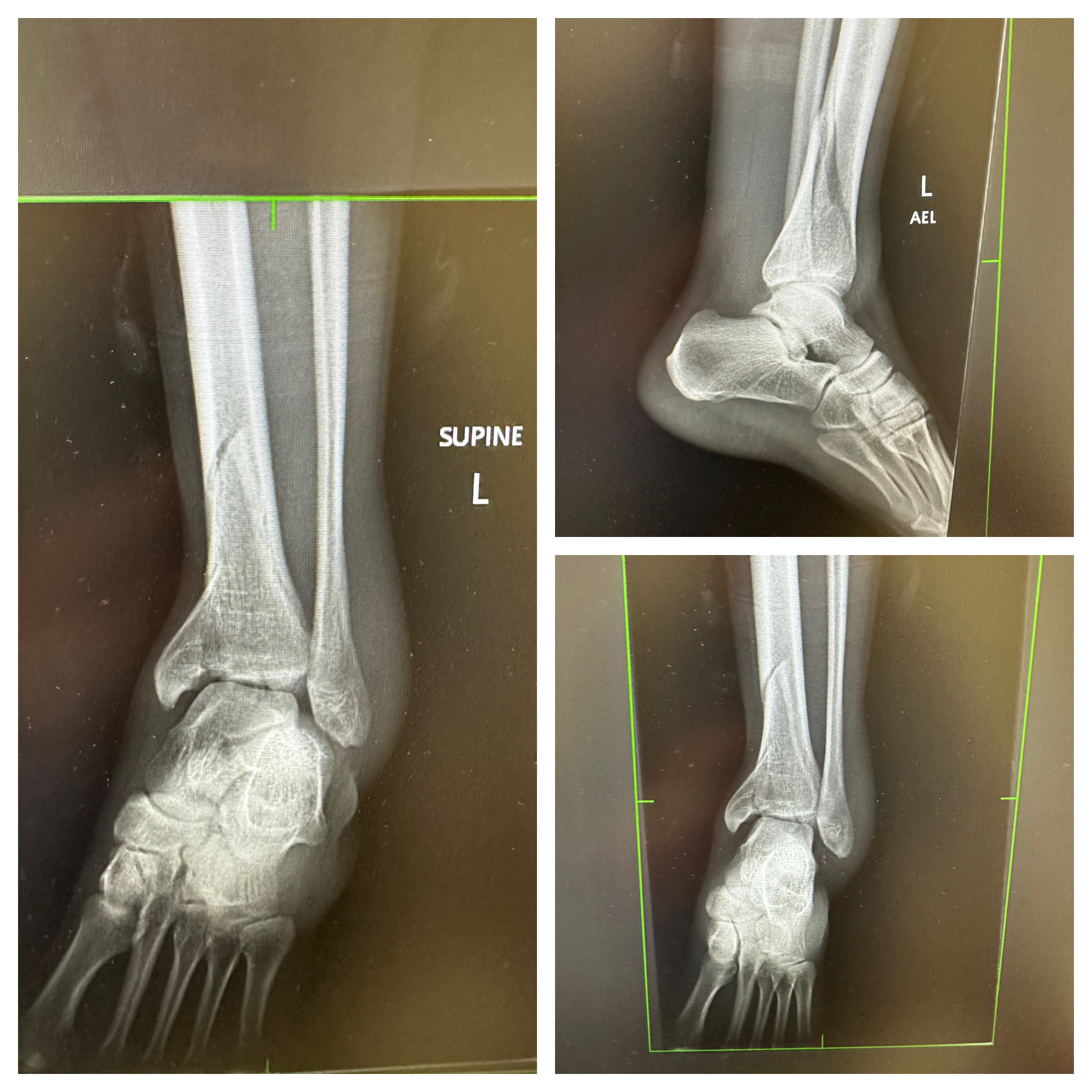 X-ray of my tibia